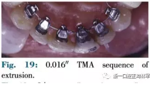 文獻(xiàn)優(yōu)秀正畸病例賞析--正畸牙周聯(lián)合治療方法病例介紹