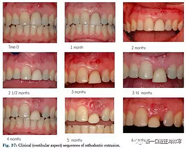 文獻(xiàn)優(yōu)秀正畸病例賞析--正畸牙周聯(lián)合治療方法病例介紹