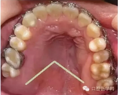 牙床骨質突起的原因和處理措施