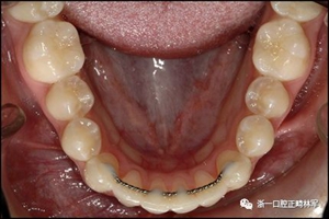 正畸文獻閱讀--固定舌側保持器作用下意外的牙齒移動