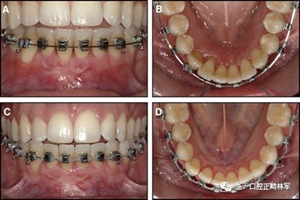 正畸文獻閱讀--固定舌側保持器作用下意外的牙齒移動