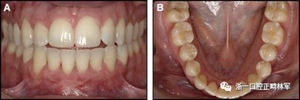 正畸文獻閱讀--固定舌側保持器作用下意外的牙齒移動
