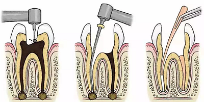 牙科學堂丨根管治療中開放的危害
