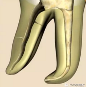 知識分享：根管治療的標準步驟