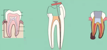 知識分享：根管治療的標準步驟