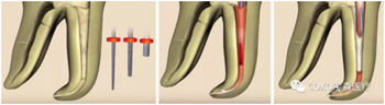 知識分享：根管治療的標準步驟