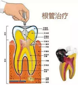 醫生，牙齒折斷不是應該補上去嗎，為啥要做根管治療？