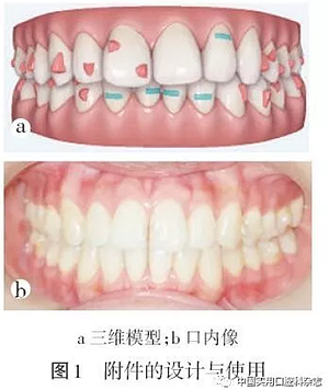 專題筆談 | 無托槽隱形矯治技術