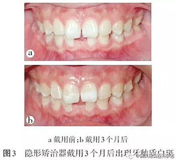 專題筆談 | 無托槽隱形矯治技術