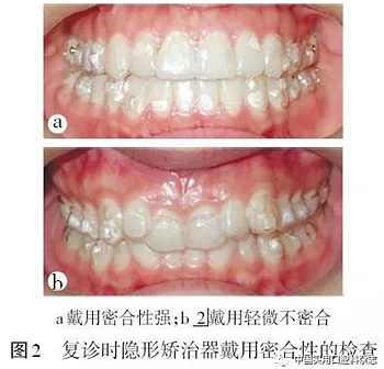 專題筆談 | 無托槽隱形矯治技術