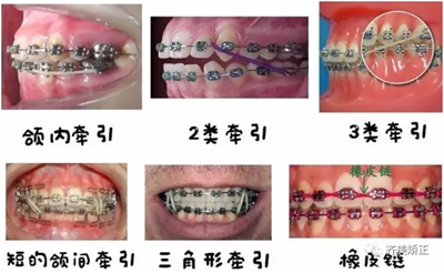 牙齒矯正，為什么要掛橡皮筋？