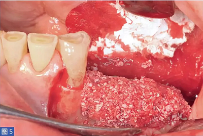 柵欄技術(shù)用于局部三維骨增量 —技術(shù)概述與病例匯報 （1）