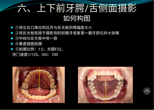 口內(nèi)照攝影方法與技巧分享