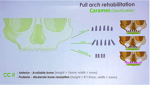 【熱點回顧】帶您深度了解無牙頜種植修復——Pro Arch