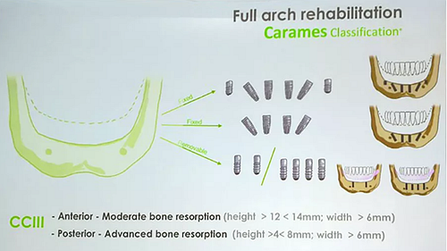 【熱點回顧】帶您深度了解無牙頜種植修復——Pro Arch