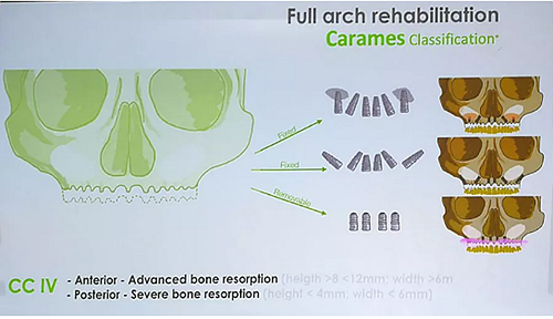 【熱點回顧】帶您深度了解無牙頜種植修復——Pro Arch