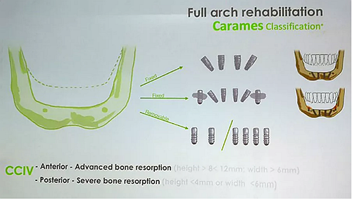 【熱點回顧】帶您深度了解無牙頜種植修復——Pro Arch