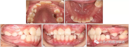 右下頜第一磨牙遠(yuǎn)中水平阻生1例
