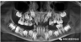 右下頜第一磨牙遠(yuǎn)中水平阻生1例