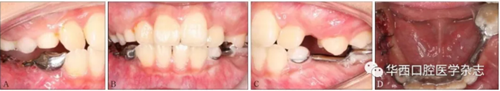 右下頜第一磨牙遠(yuǎn)中水平阻生1例