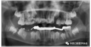 右下頜第一磨牙遠(yuǎn)中水平阻生1例