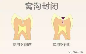 窩溝封閉劑