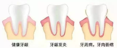 牙周炎，中國成年人后半生永遠(yuǎn)的 痛 ！