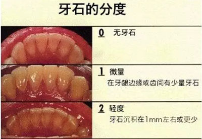 牙周炎，中國成年人后半生永遠(yuǎn)的 痛 ！