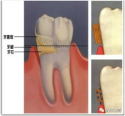 牙周炎，中國成年人后半生永遠(yuǎn)的 痛 ！