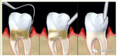 牙周炎，中國成年人后半生永遠(yuǎn)的 痛 ！