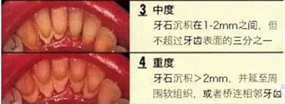 牙周炎，中國成年人后半生永遠(yuǎn)的 痛 ！