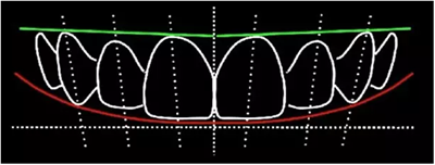 Asc全瓷角度基臺(tái)一體冠進(jìn)行種植前牙美學(xué)修復(fù)一例