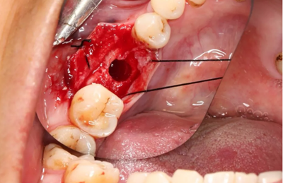 病例分享|下頜后牙牙槽嵴保存延期種植頰側(cè)骨壁吸收植骨引導(dǎo)骨再生一例