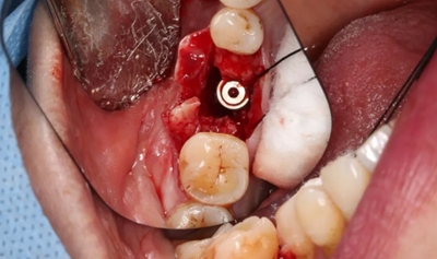 病例分享|下頜后牙牙槽嵴保存延期種植頰側(cè)骨壁吸收植骨引導(dǎo)骨再生一例