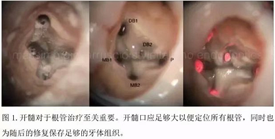 【病例分享】根管冠部預敞