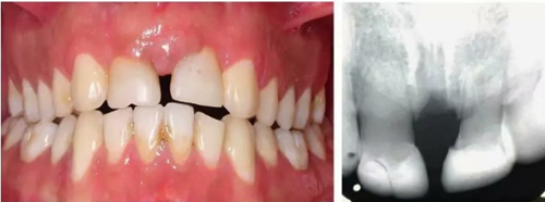 【病例分享】上頜中切牙區外傷的自體移植和正畸治療