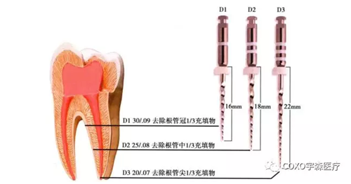 （十一期）根管充填物的清理-牙膠的去除