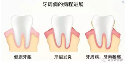 怎樣預防牙齦萎縮