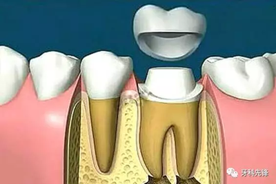 補牙不做冠，療效少一半！根管治療后牙齒已經不疼了，為什么還要戴牙冠呢？