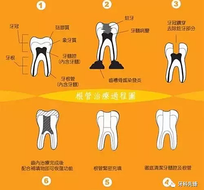 補牙不做冠，療效少一半！根管治療后牙齒已經不疼了，為什么還要戴牙冠呢？