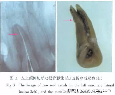 X線牙片在牙齒疑難病例診斷中的參考價(jià)值