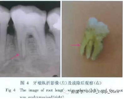 X線牙片在牙齒疑難病例診斷中的參考價(jià)值