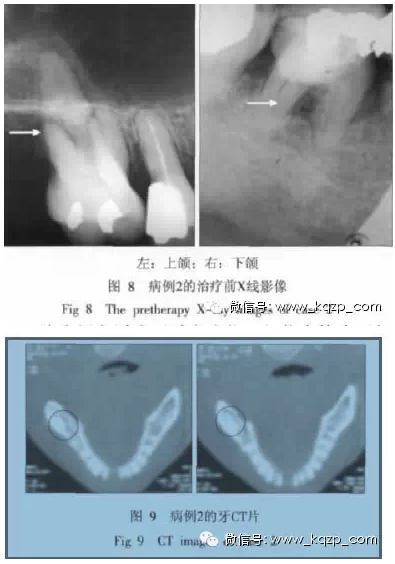 X線牙片在牙齒疑難病例診斷中的參考價(jià)值