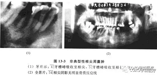 根尖周病的鑒別診斷