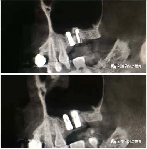 失敗上頜竇種植患者的補救