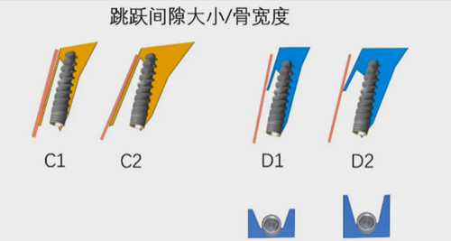 即刻種植的成功要素