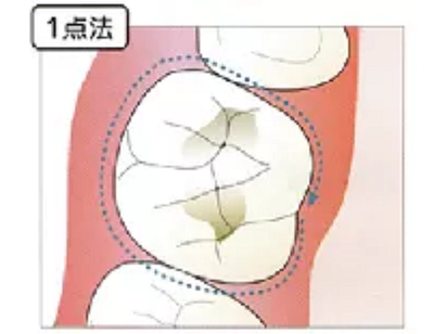 牙周袋深度測定法