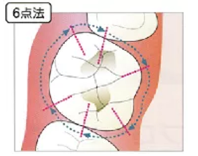 牙周袋深度測定法