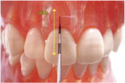牙周袋深度測定法
