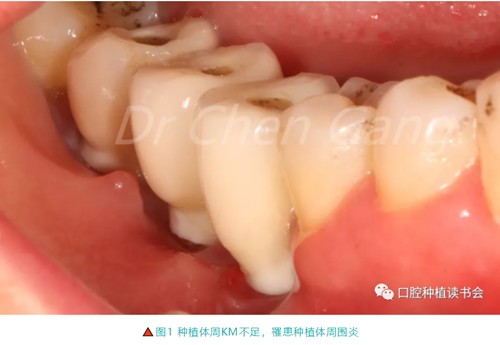 高清圖解｜游離牙齦（FGG）的獲取與移植技術